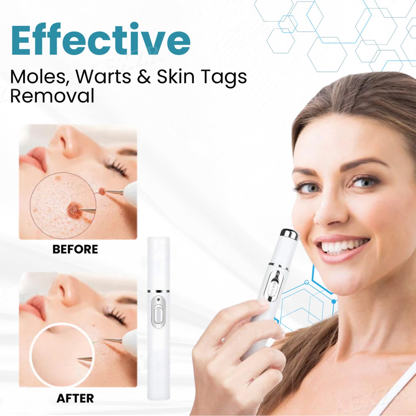 Bikenda® Non-Invasive Mole and Wart Removal Laser Pen 🔥🔥