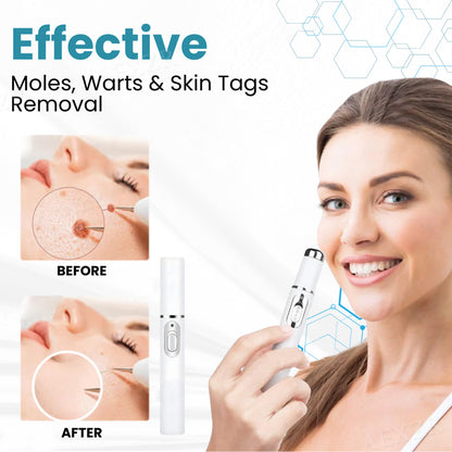 Bikenda® Non-Invasive Mole and Wart Removal Laser Pen 🔥🔥